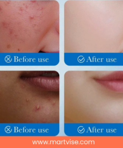 sadoer-invisible-acne-patch-pakistan.jpg – waterproof pimple stickers for clean skin